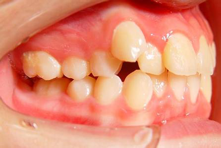 我為(wèi)什(shén)麽會(huì)長(cháng)龅牙,龅牙是(shì)怎麽來(lái)的(de)?